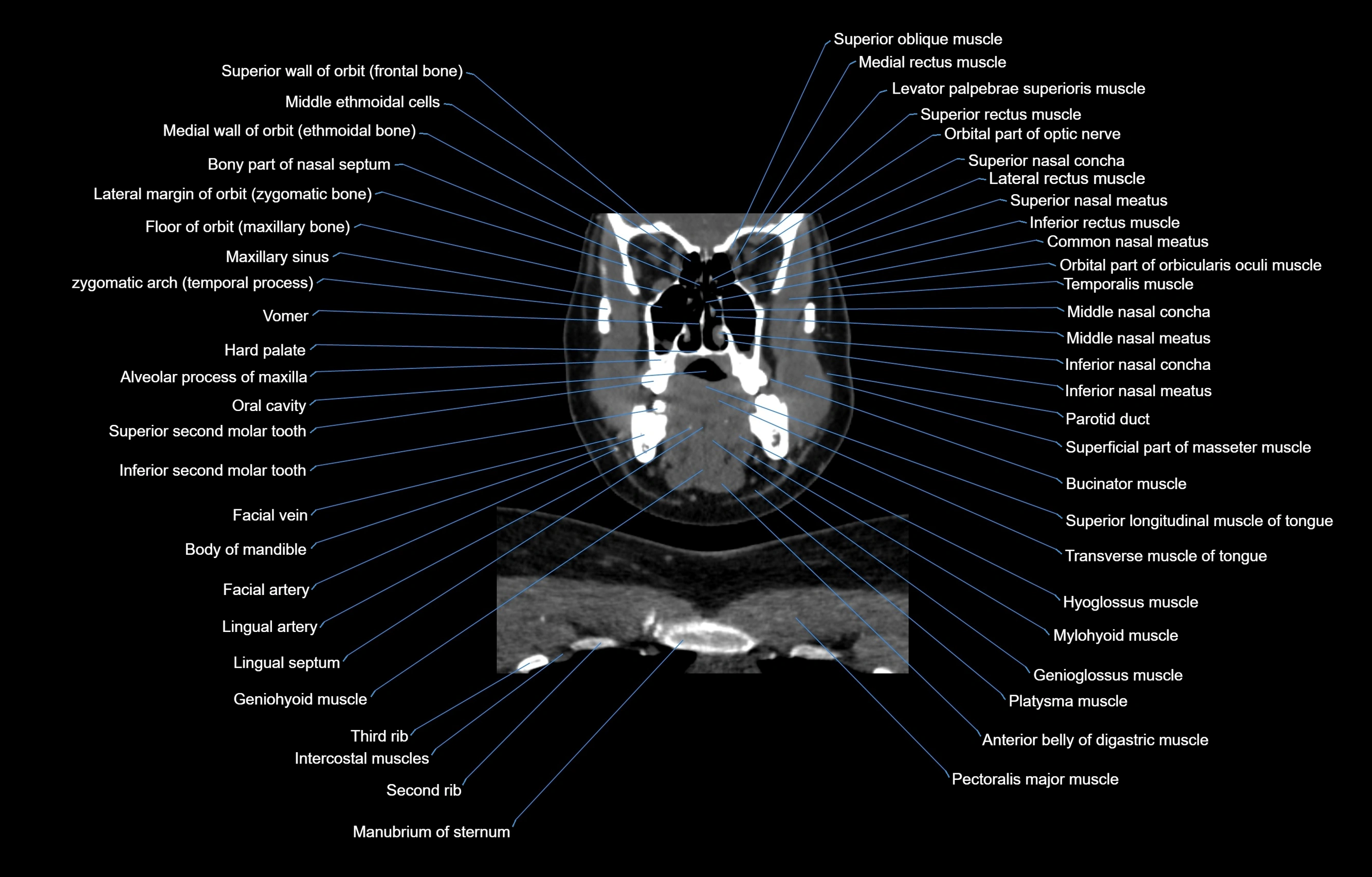 CT Neck coronal  cross sectional anatomy labelled 3D  radiology  image-00020.webp